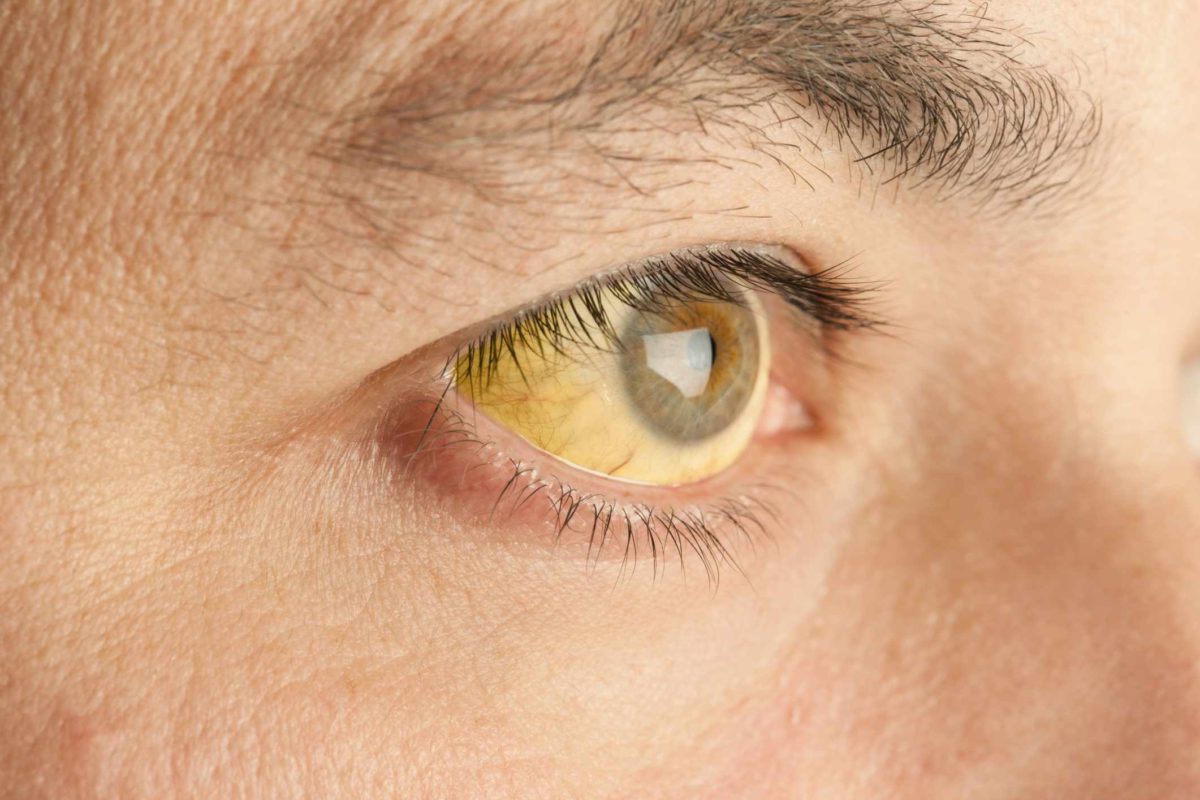 home remedies for jaundice